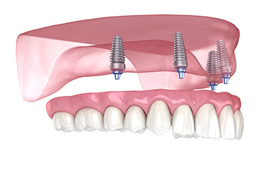 Dumont Dental Professionals | Implant Restorations, Periodontal Treatment and Implant Dentistry