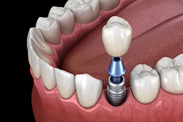 Dumont Dental Professionals | Implant Dentistry, CandidPro reg Aligners and TMJ Disorders