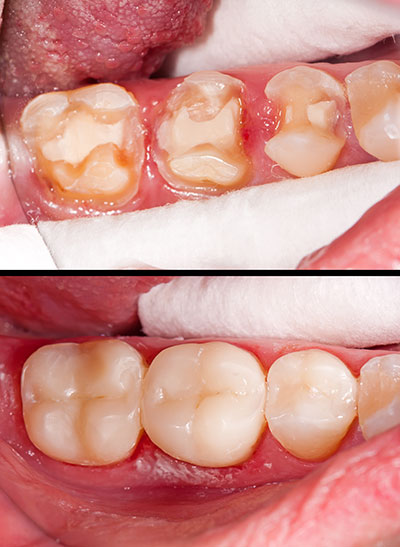 Dumont Dental Professionals | Inlays  amp  Onlays, Periodontal Treatment and Veneers