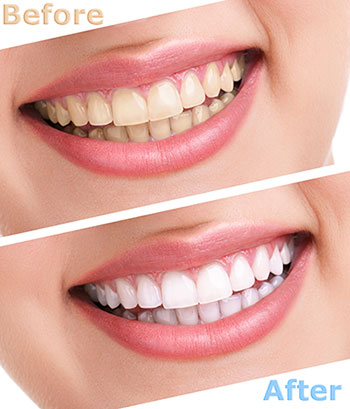 Dumont Dental Professionals | Dental Bridges, Sports Mouthguards and Emergency Treatment